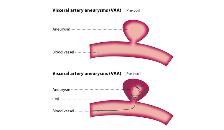 Aneurysm Treatment | Vascular Surgeon Cape Town