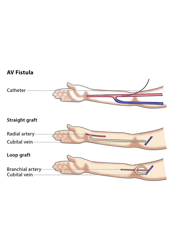 Formation of AV Fistulas | Vascular Surgeon Cape Town